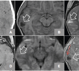 brain