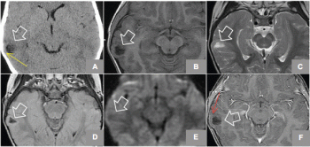 brain